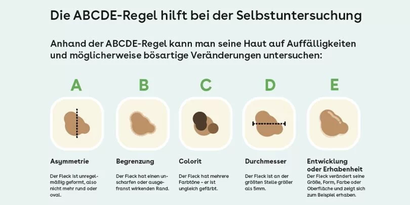 Die ABCDE-Regel hilft bei der Selbstuntersuchung.