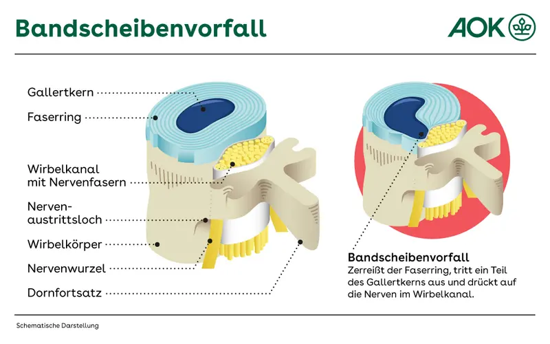 Eine grafische Darstellung zeigt den anatomischen Aufbau einer Bandscheibe sowie einen Bandscheibenvorfall im Vergleich. Bei der gesunden Bandscheibe werden die Bestandteile gezeigt: Wirbelkörper mit aufliegender Bandscheibe. Diese besteht aus einem Faserring mit eingeschlossenem Gallertkern. Dahinter liegt der Wirbelkanal mit Nervenfasern. Beim Bandscheibenvorfall wölbt sich der Gallertkern nach außen und drückt auf die Nerven im Wirbelkanal.