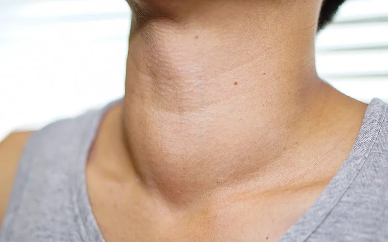 Die Schilddrüsenunterfunktion verursacht eine abnormale Vergrößerung am Hals einer Frau.