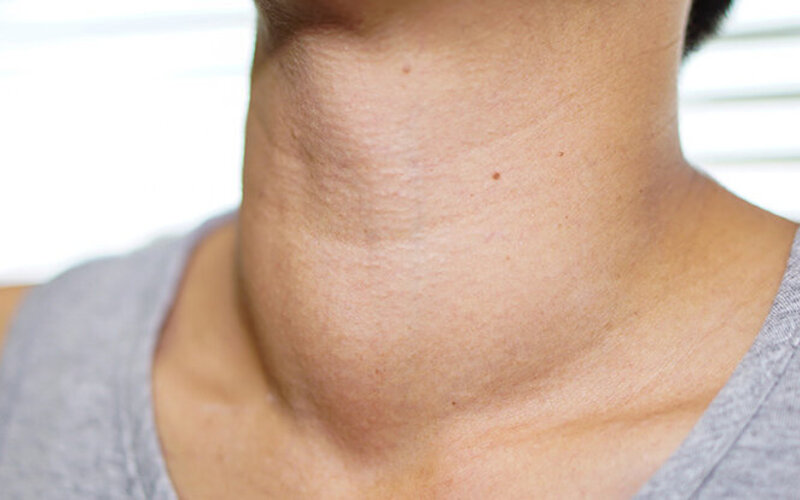 Die Schilddrüsenunterfunktion verursacht eine abnormale Vergrößerung am Hals einer Frau.
