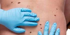 Ein Arzt untersucht mit dem Dermatoskop ein Muttermal. Wird Hautkrebs frühzeitig erkannt, sind die Heilungschancen gut.