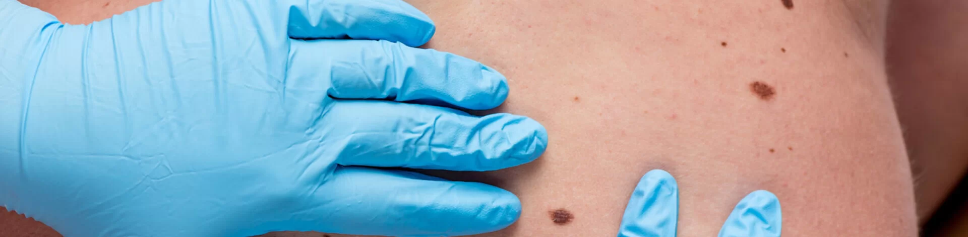 Ein Arzt untersucht mit dem Dermatoskop ein Muttermal. Wird Hautkrebs frühzeitig erkannt, sind die Heilungschancen gut.