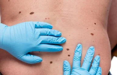 Ein Arzt untersucht mit dem Dermatoskop ein Muttermal. Wird Hautkrebs frühzeitig erkannt, sind die Heilungschancen gut.