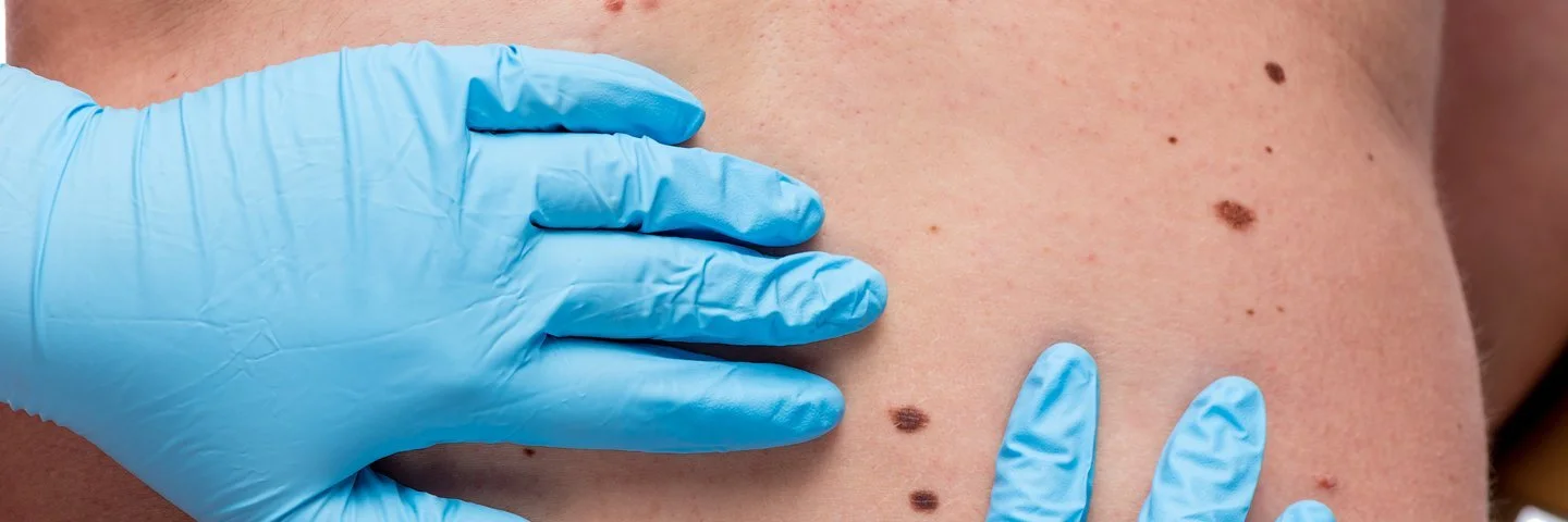 Ein Arzt untersucht mit dem Dermatoskop ein Muttermal. Wird Hautkrebs frühzeitig erkannt, sind die Heilungschancen gut.