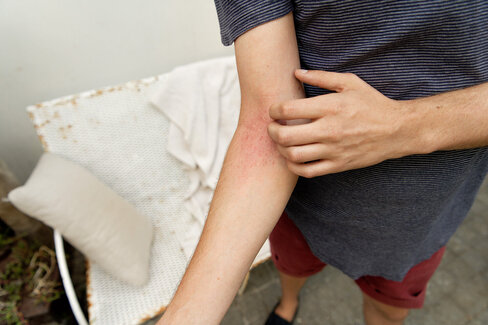 Eine Person kratzt sich am Arm. Dahinter kann eine Kontaktallergie stecken.
