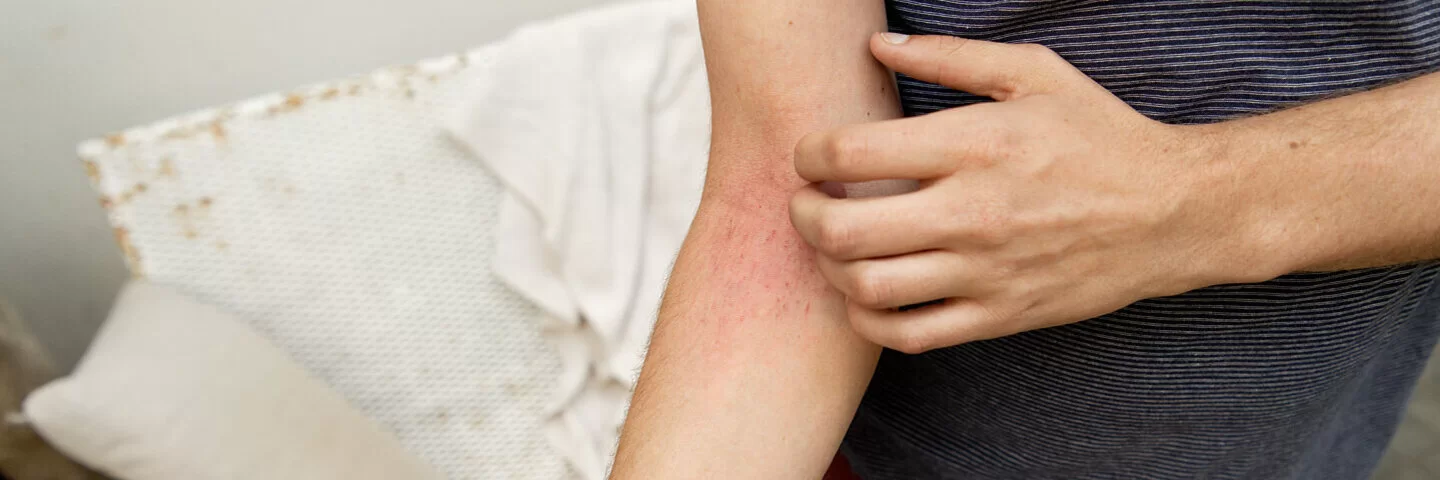 Eine Person kratzt sich am Arm. Dahinter kann eine Kontaktallergie stecken.