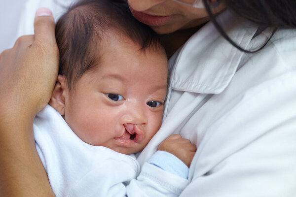 Ein Baby mit einer Lippenspalte liegt in den Armen einer Frau, die das Kind besorgt ansieht.