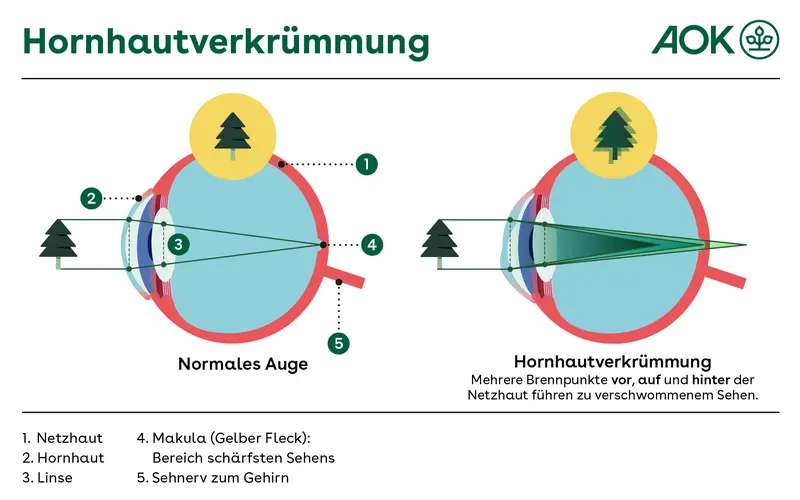 Eine grafische Darstellung zeigt ein normales Auge im Vergleich zu einem Auge mit Hornhautverkrümmung. Beim normalen Auge werden die Bestandteile gezeigt: Netzhaut, Hornhaut, Linse, Makula und Sehnerv sowie die Lichtbrechung in der Hornhaut und der Linse. Durch eine verkrümmte Hornhaut ist die Lichtbrechung verschoben und vervielfacht, was zu unscharfem Sehen führt.