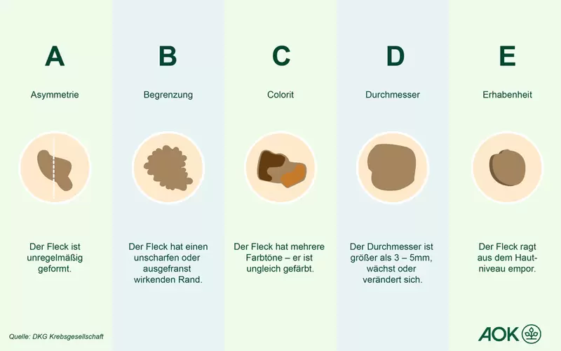 Eine Übersichtsgrafik über die ABCDE-Regel, um schwarzen Hautkrebs zu erkennen.