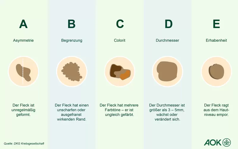 Eine Übersichtsgrafik über die ABCDE-Regel, um schwarzen Hautkrebs zu erkennen.