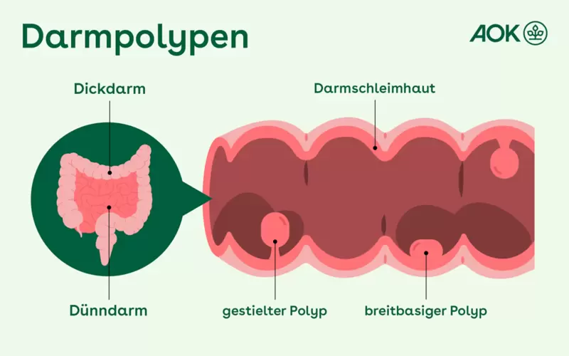 Schematische Darstellung des Dünn- und Dickdarms und unterschiedlicher Darmpolypen.