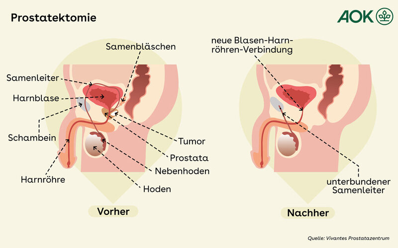 Vorher-Nachher-Darstellung für eine radikale Prostatektomie.