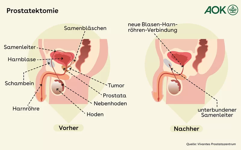Vorher-Nachher-Darstellung für eine radikale Prostatektomie.