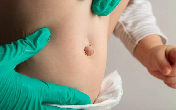 Nahaufnahme: Zwei Hände in dünnen grünen medizinischen Handschuhen tasten den nackten Bauch eines aufrechtstehenden Kleinkindes ab, das nur mit einer Windel bekleidet ist. Der Bauchnabel des Kindes stülpt sich sichtlich nach außen.