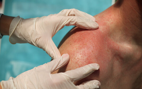 Patient mit Lupus Erythematodes lässt seinen Hautausschlag untersuchen.