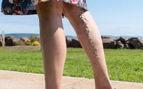 An dem Bein einer jungen Frau zieht sich eine Krampfader entlang.