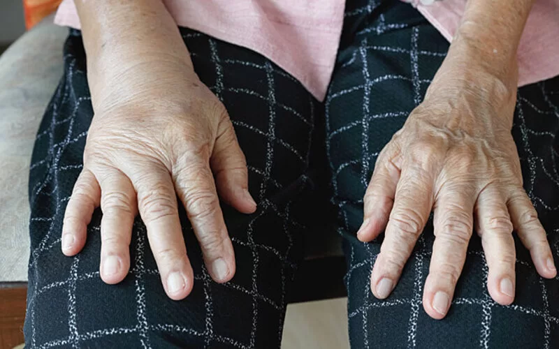 Hände einer alten Frau, von denen eine von Ödemen angeschwollen ist.