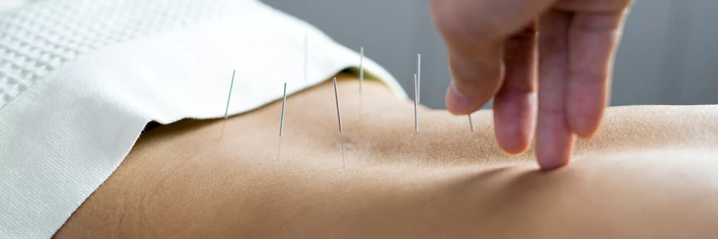 Arzt macht eine Akupunktur bei einer Patientin mit chronischen Rückenschmerzen.