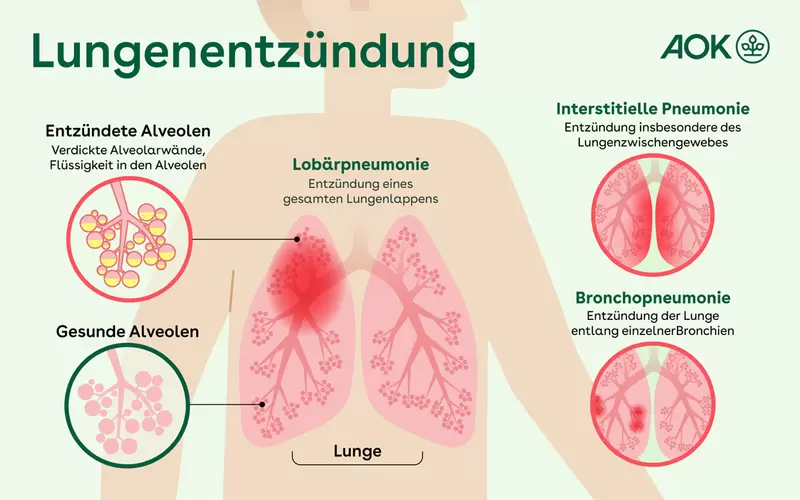 Infografik zur Lunge mit gesunden und entzündeten Lungenflügeln.