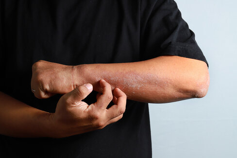 Ein Mann kratzt sich am Unterarm. Dabei kann es sich um Neurodermitis handeln. Die AOK hilft weiter. 