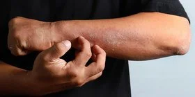 Ein Mann kratzt sich am Unterarm. Dabei kann es sich um Neurodermitis handeln. Die AOK hilft weiter. 