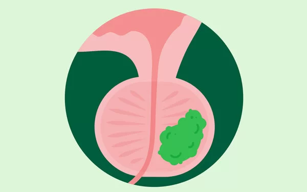 Die Illustration zeigt eine Prostata mit Protatakrebs.