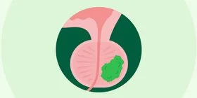 Die Illustration zeigt eine Prostata mit Protatakrebs.