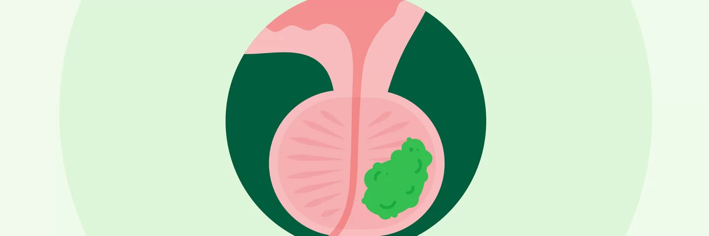 Die Illustration zeigt eine Prostata mit Protatakrebs.