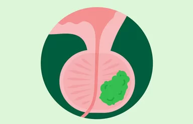 Die Illustration zeigt eine Prostata mit Protatakrebs.