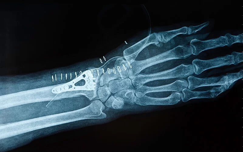 Das Röntgenbild einer Hand mit Teilen des Unterarms. Zu sehen ist, dass eine Fraktur am Handgelenk mit einer Metallplatte fixiert wurde.