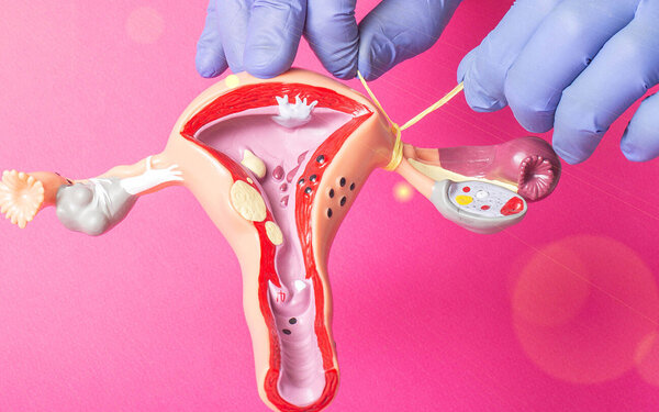 Eine Person zeigt an einem Anatomiemodell, wie die Sterilsation der Frau ablaufen kann.