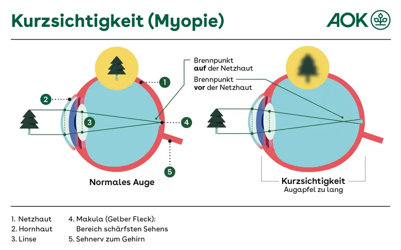 Eine grafische Darstellung zeigt ein normales Auge im Vergleich zu einem kurzsichtigen Auge. Beim normalen Auge werden die Bestandteile gezeigt: Netzhaut, Hornhaut, Linse, Makula und Sehnerv sowie die Lichtbrechung in der Hornhaut und der Linse. Beim kurzsichtigen Auge ist der Augapfel länger. Die Lichtbrechung ist daher verschoben, was zu unscharfem Sehen führt.