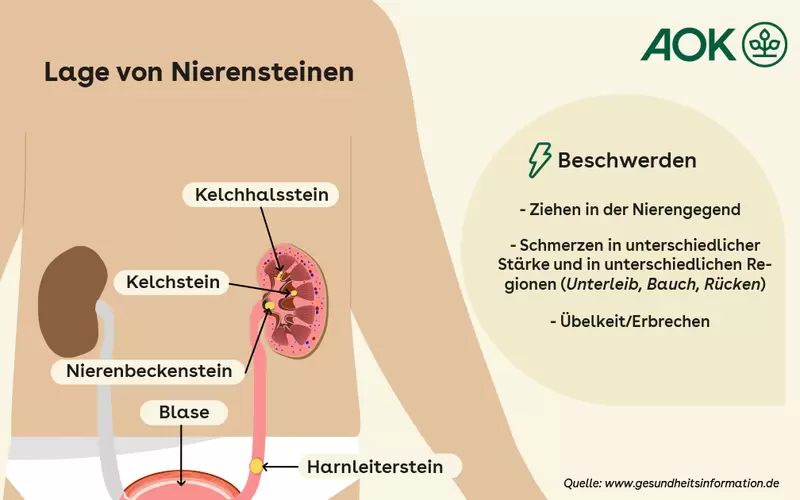 Schaubild zur Lage der Nieren und möglichen Nierensteinen.