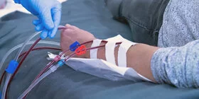 Ein Mann liegt in einem Dialysezentrum auf einer Liege. Medizinisches Personal legt ihm am rechten Arm einen Zugang für die Hämodialyse.
