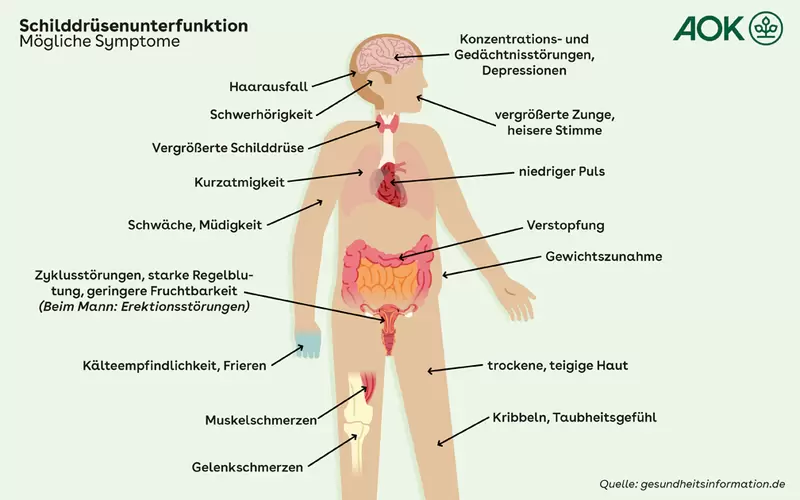 Übersichtsgrafik über die Symptome einer Schilddrüsenunterfunktion.