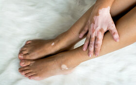Eine Frau mit Vitiligo legt ihre rechte Hand auf das linke Bein, wobei die Weißfleckenkrankheit sichtbar wird.
