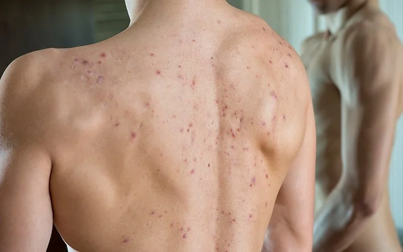 Der Rücken einen Mannes. Auf ihm sind viele Akne-Pusteln erkennbar.