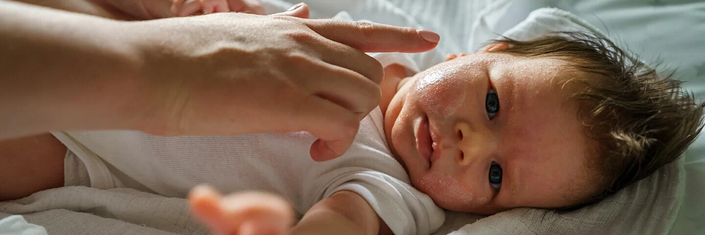 Eine Frau cremt das Gesicht eines Babys mit Neurodermitis ein.