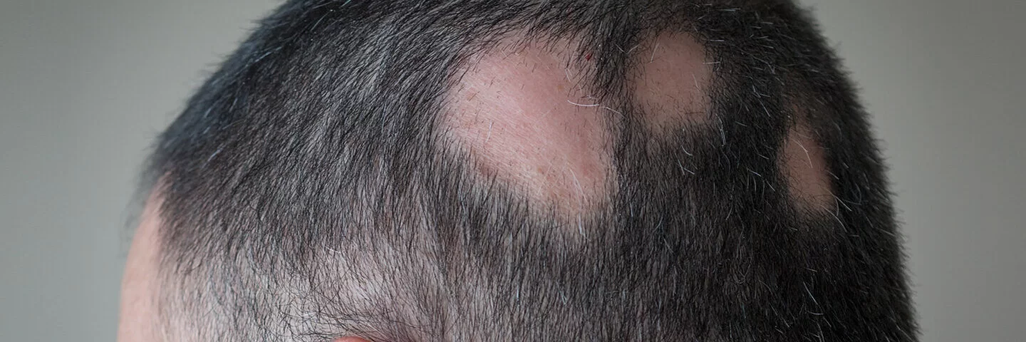Ansicht des Hinterkopfs eines Mannes mit kahlen Stellen. Der Mann leidet unter kreisrundem Haarausfall.