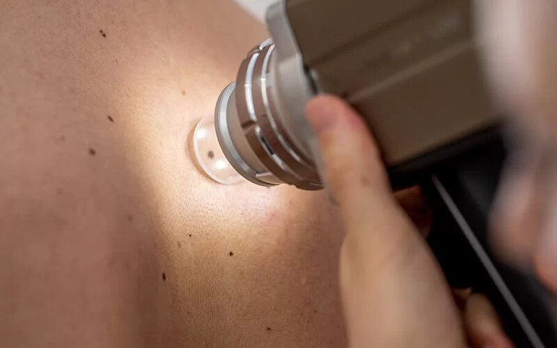Dermatologe untersucht mit einem Dermatoskop die Haut eines Patienten.