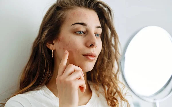 Eine junge Frau betrachtet ihre Haut im Spiegel und zeigt mit dem Finger auf eine Stelle an der Wange, die von einem Ausschlag betroffen ist.