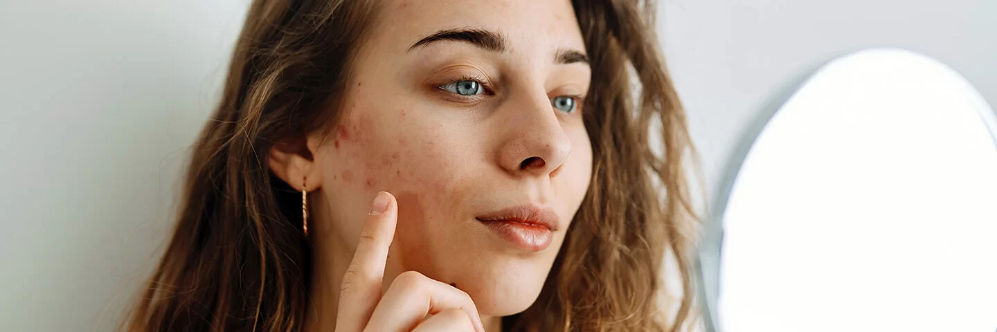 Eine junge Frau betrachtet ihre Haut im Spiegel und zeigt mit dem Finger auf eine Stelle an der Wange, die von einem Ausschlag betroffen ist.