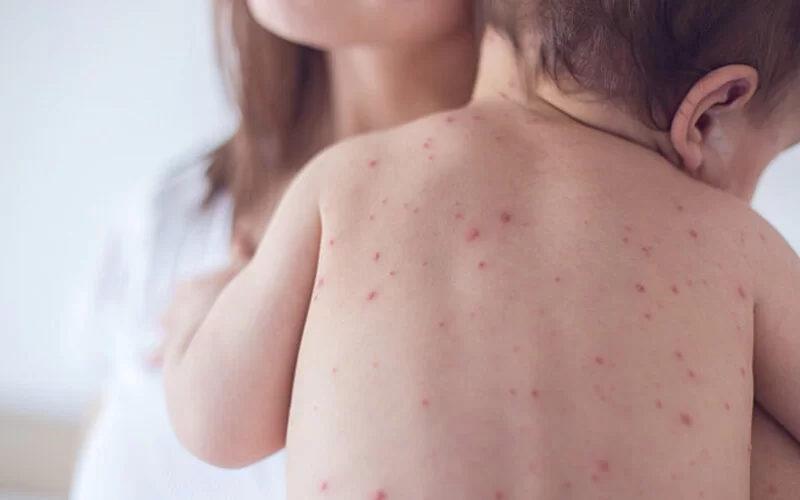 Ein Baby ist auf dem Arm einer Frau und hat Ausschlag in Folge einer Kinderkrankheit auf dem Rücken.