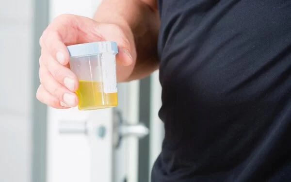 Ein Patient hält einen Becher mit einer Urinprobe f�ür einen Urintest in der Hand.