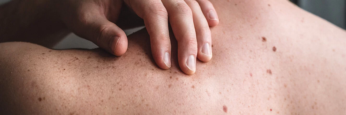 Mann untersucht seine Haut, um Hautkrebs rechtzeitig zu entdecken.