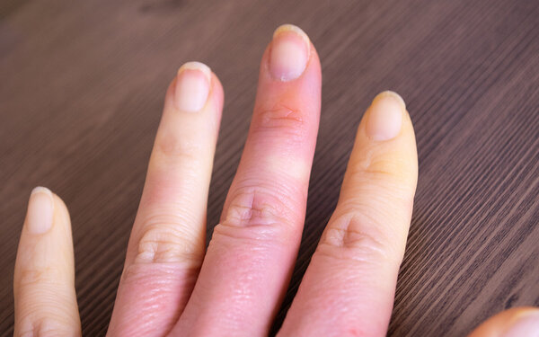 Ein Frau hält ihre Hand ins Bild, zu sehen sind Durchblutungsstörungen aufgrund des Raynaud-Syndroms.
