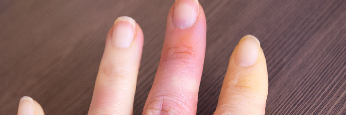 Ein Frau hält ihre Hand ins Bild, zu sehen sind Durchblutungsstörungen aufgrund des Raynaud-Syndroms.
