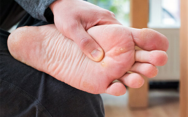 Ein Mann zeigt seine Warze auf der Fußsohle.