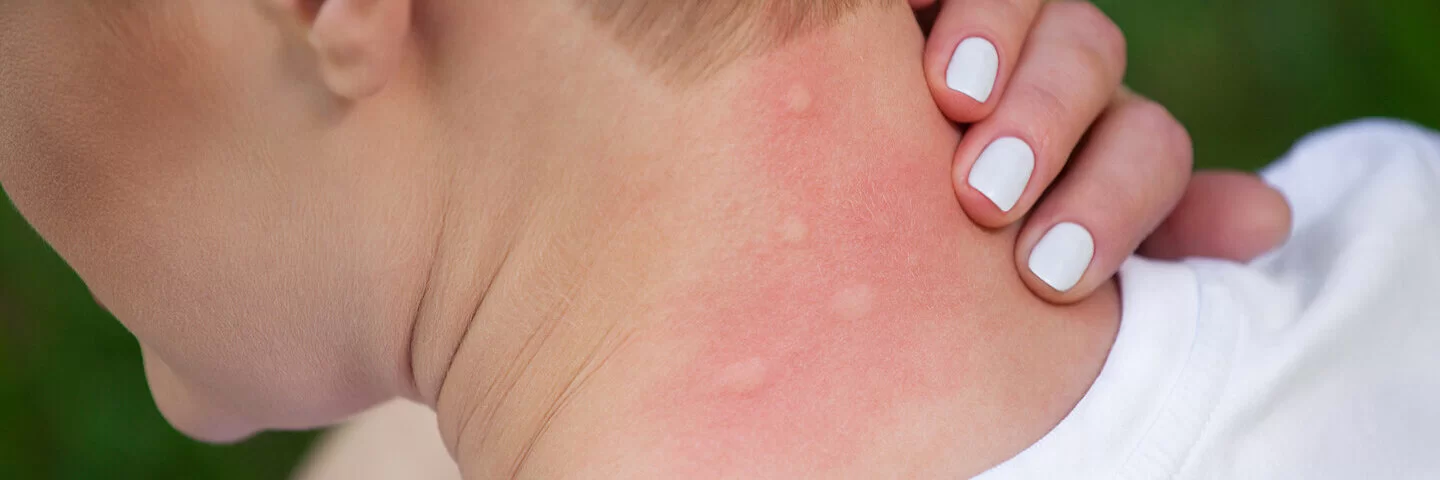 Frau wurde mehrfach im Nacken von Mücken gestochen und leidet an einer Insektengiftallergie.