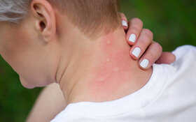 Frau wurde mehrfach im Nacken von Mücken gestochen und leidet an einer Insektengiftallergie.